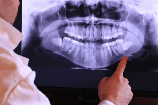 Best Emergency Wisdom Teeth Removal in Ripon, CA